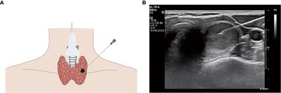 Predictors and a prediction model for positive fine needle aspiration biopsy in C-TIRADS 4 thyroid nodules